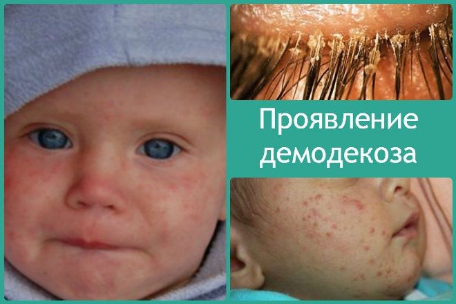 demodekoz-u-detej-proyavlenie.jpg