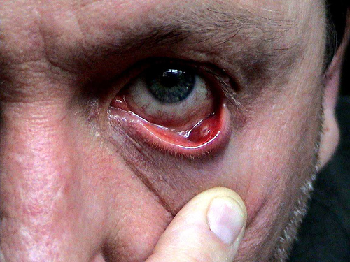 халязион в глазу