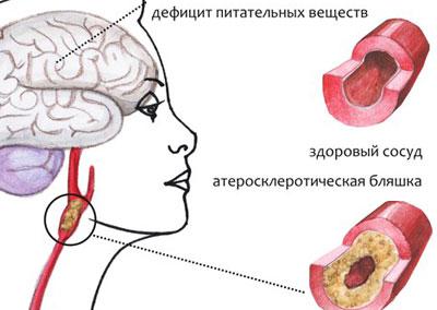 Проявление энцефалопатии