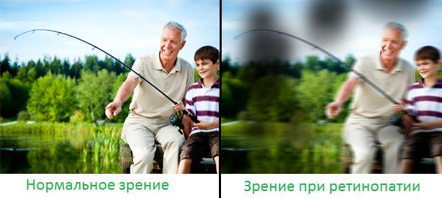 ретинопатия симптомы