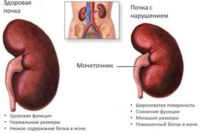 Здоровая и больная почка