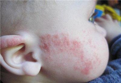 Сыпь при дисбактериозе