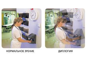 симптомы диплопии