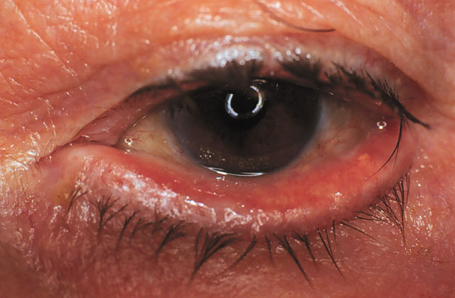 симптомы красного глаза