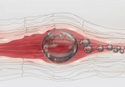 Газовая эмболия