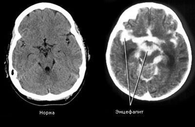 Мозг при энцефалите