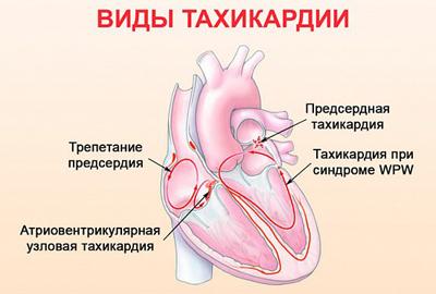 Тахикардия