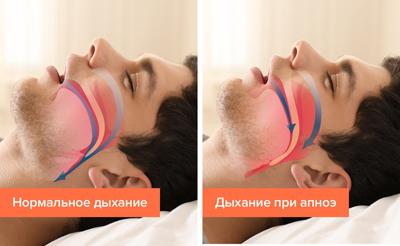 Апноэ во сне