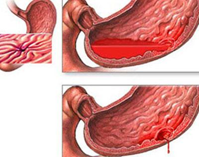 Желудочное кровотечение