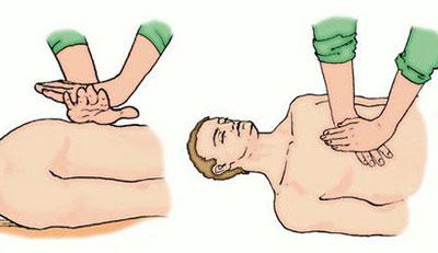 Непрямой массаж сердца