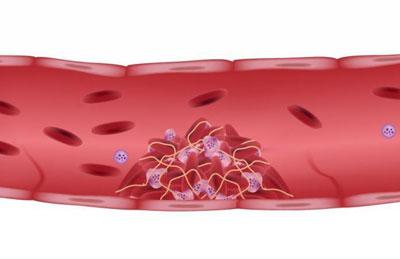 Возникновение тромба