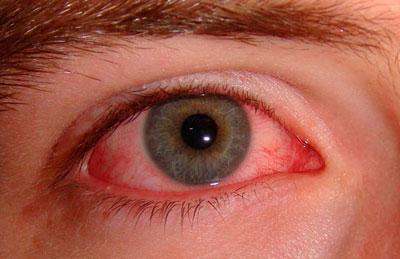 Покраснение глаза