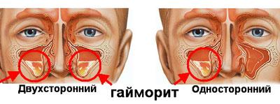 Проявление гайморита