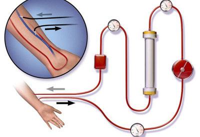 Процедура гемосорбции