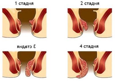 Стадии геморроя