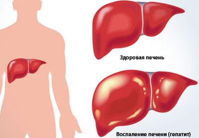 Печень при гепатите