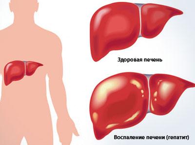 Проявление гепатита