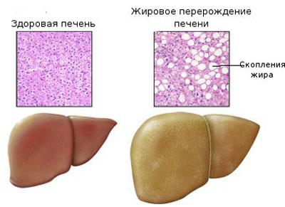 Гепатоз печени