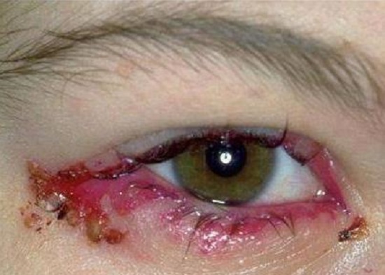 острая форма герпеса на глазу