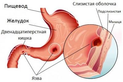 Язвенная болезнь