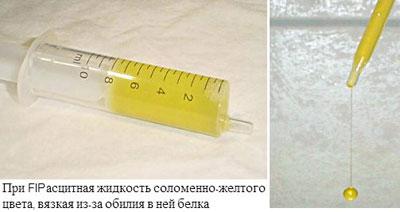 Асцитная жидкость при короновирусе