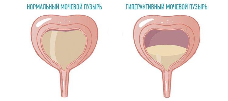 giperaktivnyj-mochevoj-puzyr