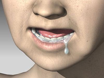 Обильное слюновыделение