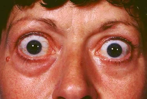 лечение выпученных глаз