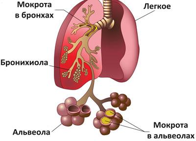 Проявление пневмонии