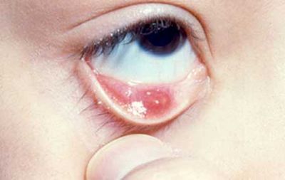 нижнее веко, воспаление