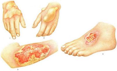 Язвы на теле