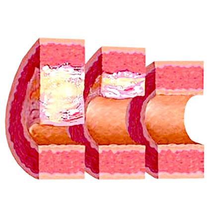 Снижения уровня холестерина.