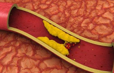 Холестериновая бляшка