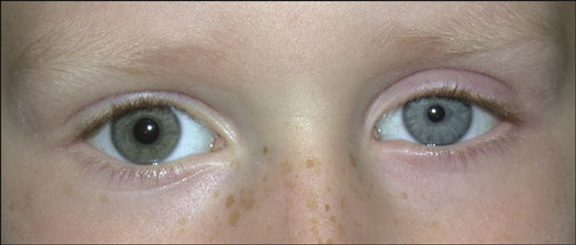 у малышей косоглазие