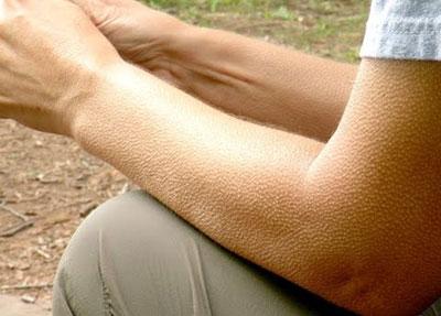 Гусиная кожа на руках