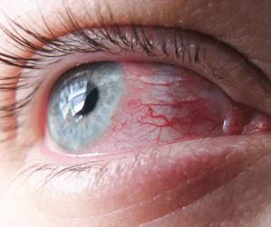 hronicheskiy-konyunktivit-simptomy