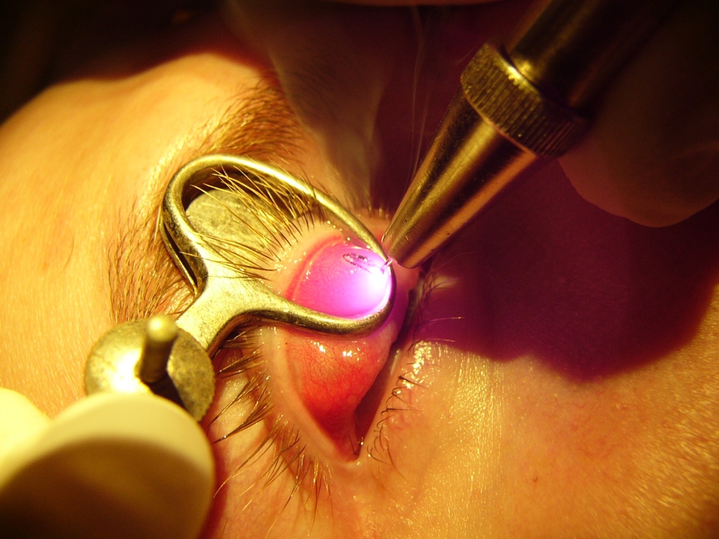 лазерное удаление