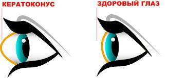 причины кератоконуса