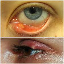 глаз больной