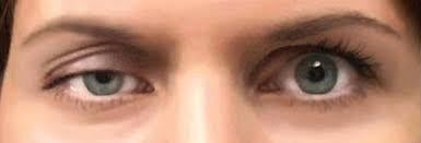 косоглазие особенности