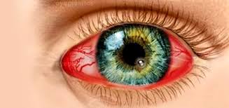 красный глаз от кератита