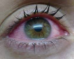 болезнь глаза
