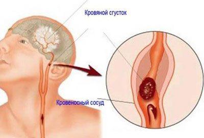 Проявление стенокардии
