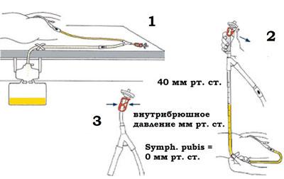 Определение внутрибрюшного давления
