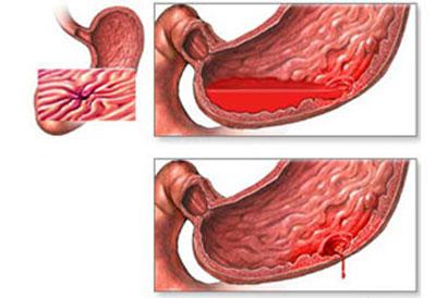 Желудочное кровотечение