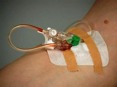 Катетер в вену