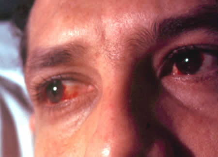 кератит и воспаление