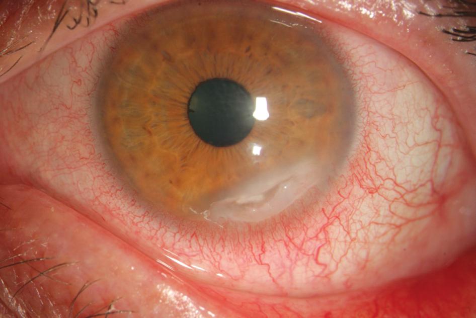 кератит и виды