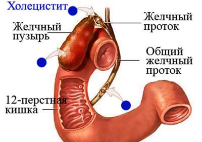 Проявление холецистита