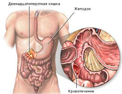 Желудочное кровотечение